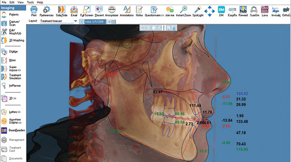 Dolphin 3D software makes it easy to orient, rotate, adjust and analyze 3D images of craniofacial anatomy.