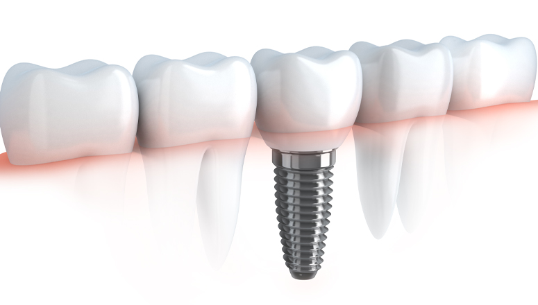 tooth implant